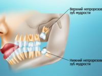 Про зуби мудрості