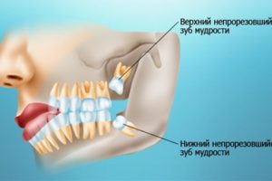 Про зуби мудрості